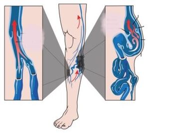 Priežastys, simptomai