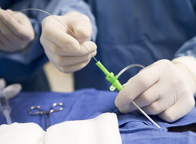 Radijo dažnio abliacija